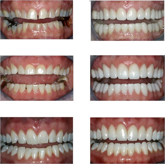 Bruxism Bellville Cape Town