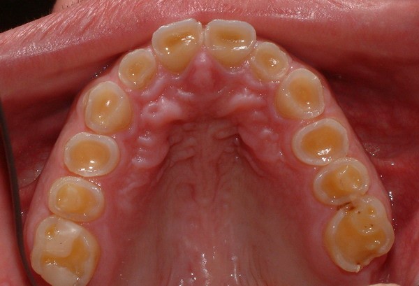 Bruxism Bellville Bruxism Bellville