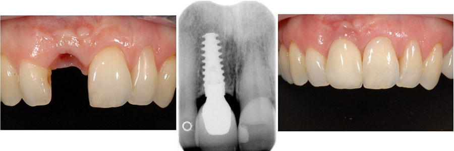 Implants Bellville Implants Bellville