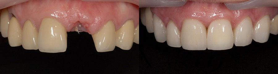 Implants Single Tooth