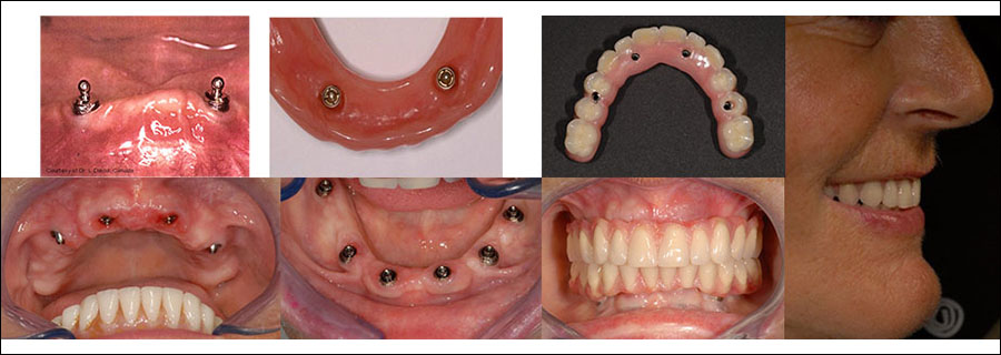 Replacing All Teeth With Implants
