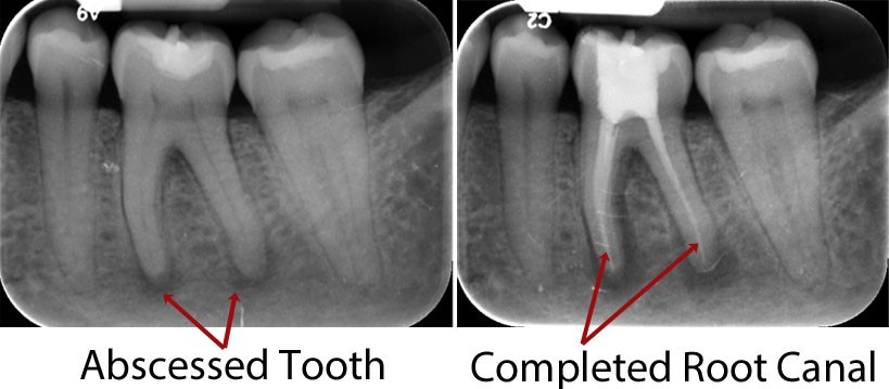 Root Canal Bellville