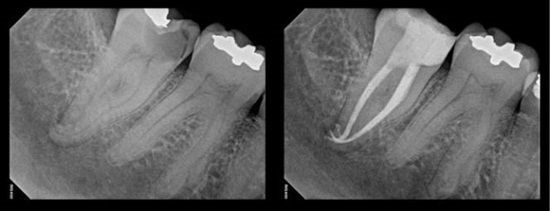 Root Canal Cape Town