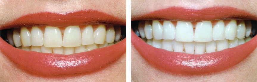 Tooth Whitening Bellville Cape Town