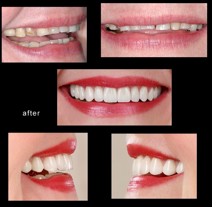 Veneers Cape Town