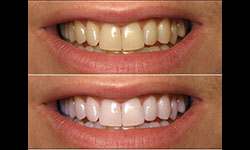 Teeth Whitening Bellville